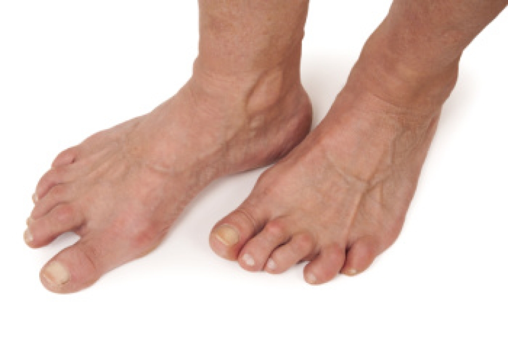 Rheumatoid Arthritis and Foot Health