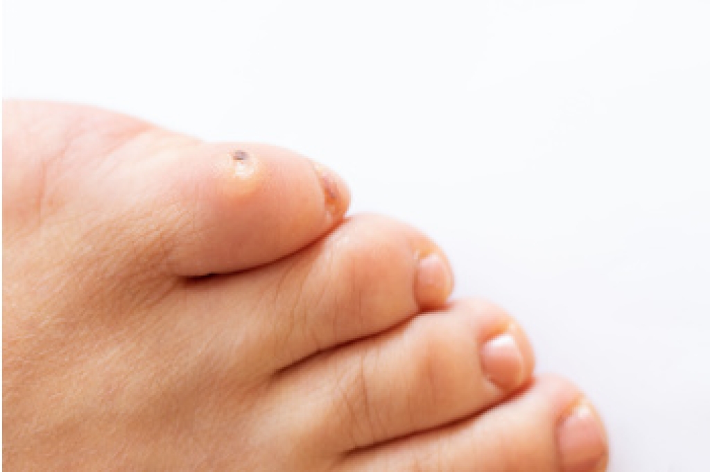 Corns and When to Seek Podiatric Care