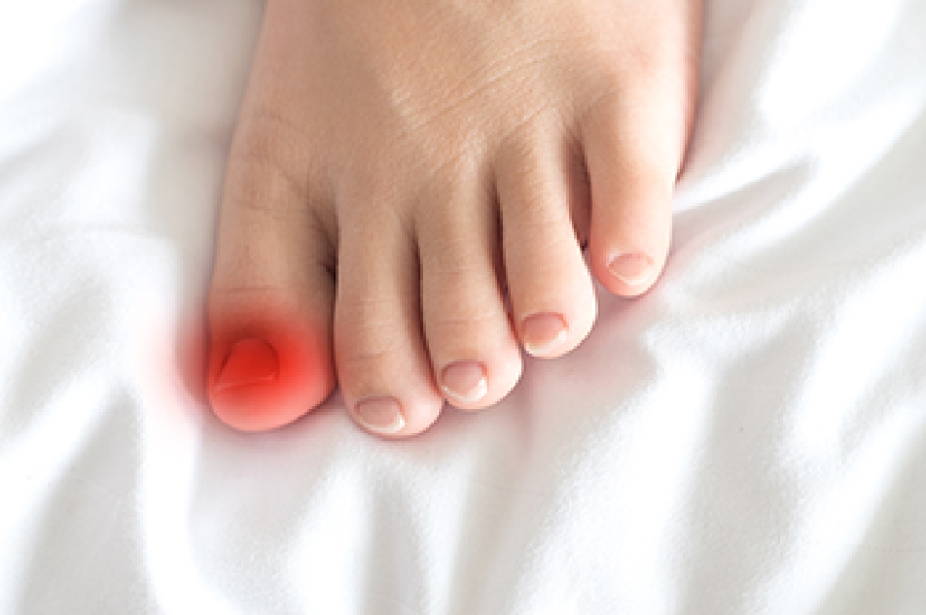 A Closer Look at Painful Ingrown Toenails