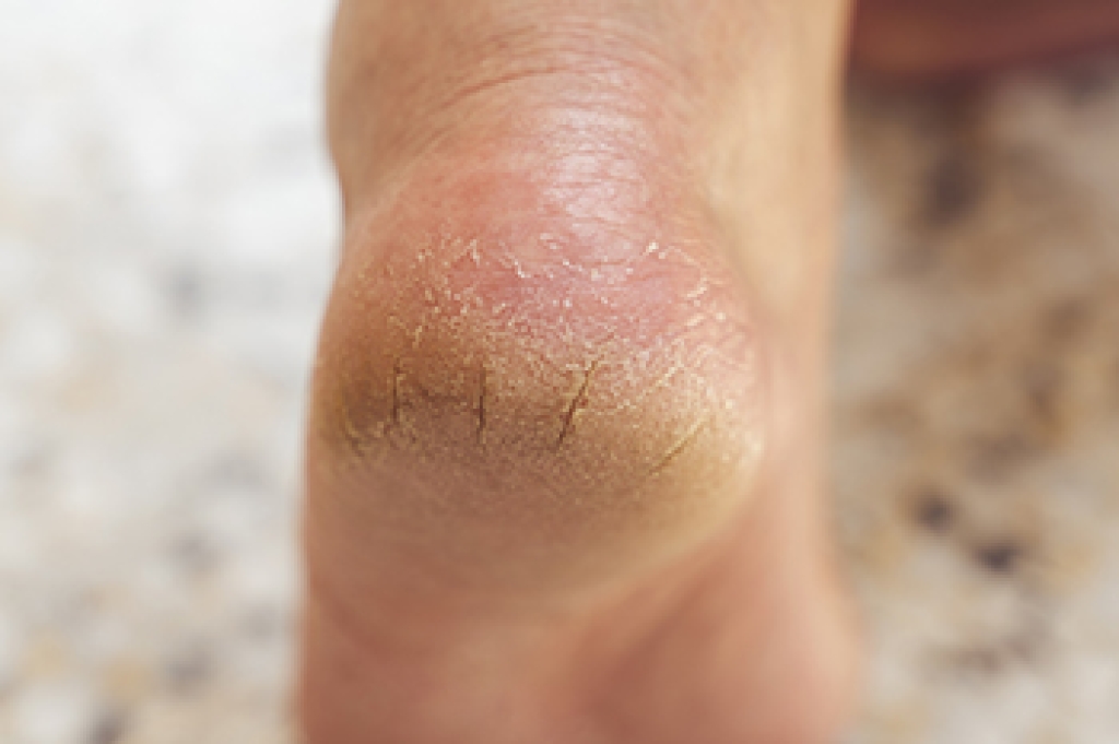 Why Running Can Lead to Cracked Heels