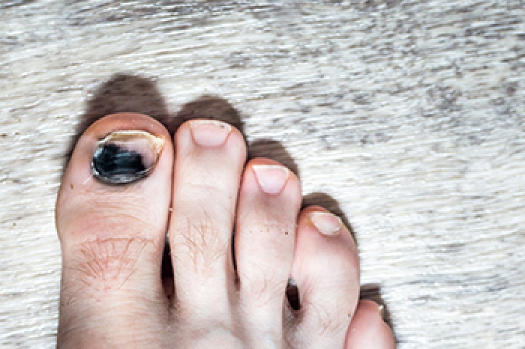 Black Toenail From Running