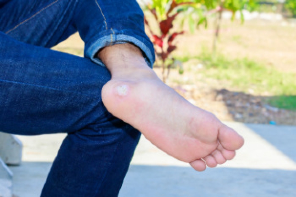 Plantar Warts and Professional Care
