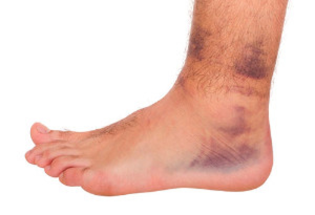 Causes and Types of Ankle Pain During Sporting Activity
