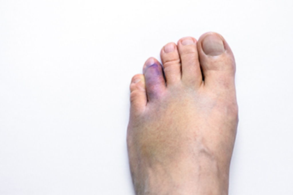 Treatment Options for Broken Toes