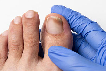 toenail fungus