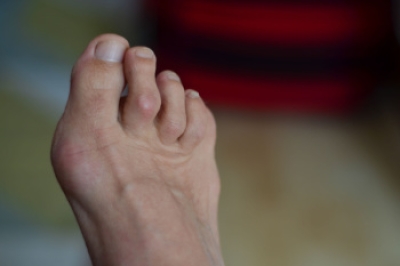 What Are Hammer or Claw Toes?