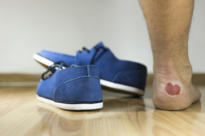 Foot Blisters and How to Protect Your Feet