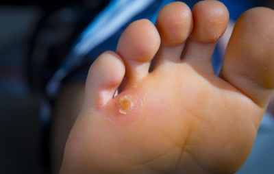 Corns and Calluses: Similar Yet Different