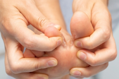 Symptoms and Treatment of Athlete's Foot
