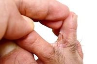 Understanding and Managing Athlete’s Foot