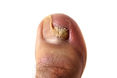 Understanding Toenail Fungus and Treatment Options